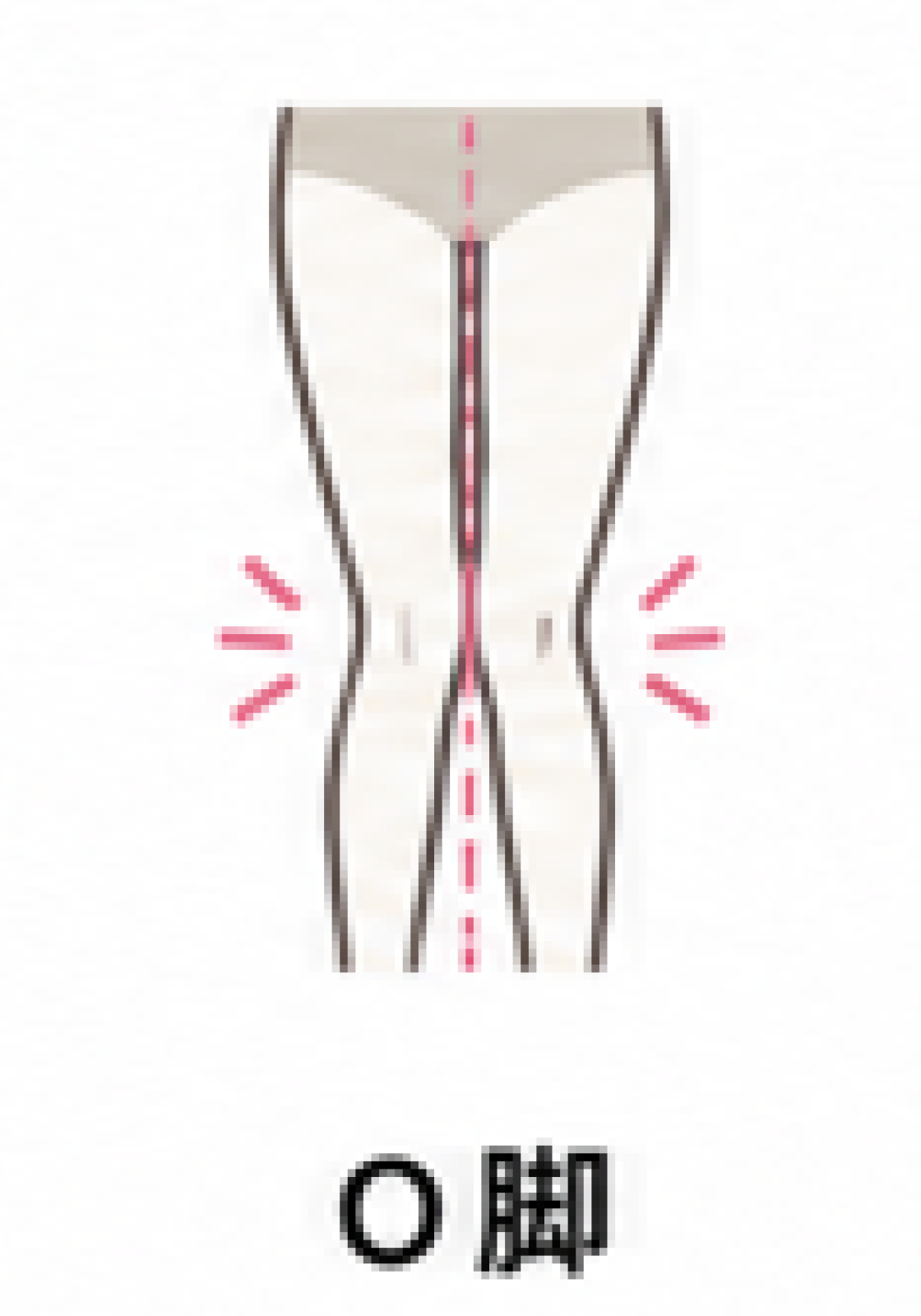 O脚